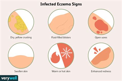 Infected Eczema Symptoms Pictures And Treatment