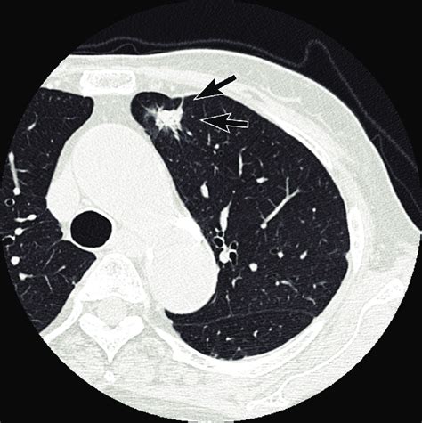 Computed Tomography Demonstrates A Small Spiculated Lung Mass Periphery