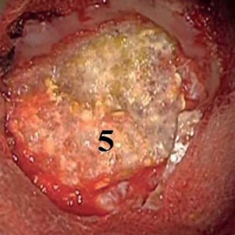 An Intraoperative Image A Tachocomb Patch 4 Shown With Arrows Is