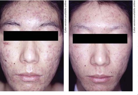 Figure 3 From A Case Of Acne Fulminans In A Patient With Ulcerative