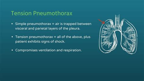 Chest Trauma Tension Pneumothorax Youtube