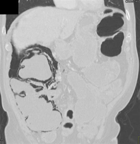 Impressive Pneumatosis Coli In 3d Colon Case Studies Ctisus Ct Scanning