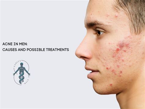Acne In Men Causes And Possible Treatments Vanity Male