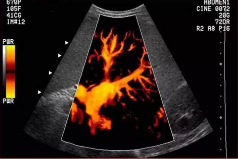 Anatomía Vascular Importante Y Ultrasonografia Doppler Color