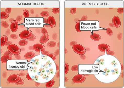 Iron deficiency anemia is the most common type of anemia in the u.s. Iron deficiency anaemia | Alale is the most powerfull ...