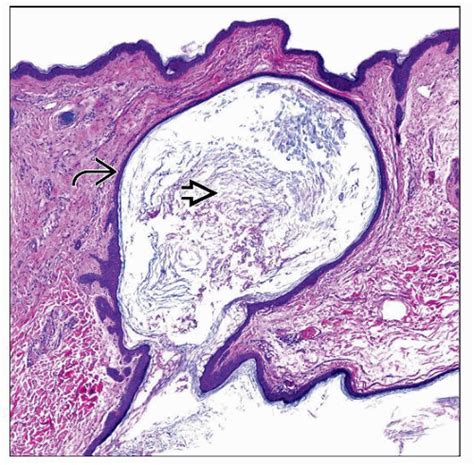 Epidermoid Cyst Histology