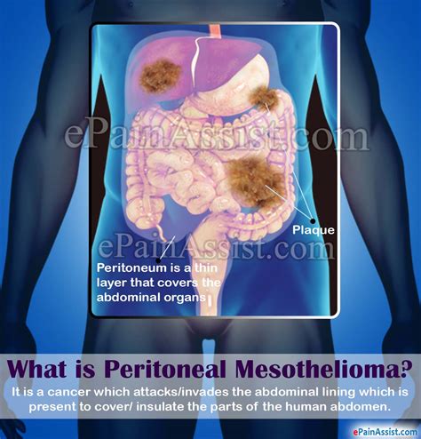 Get answers for peritoneal mesothelioma top 10 questions to ask your doctor about mesothelioma answer 3 quick questions and we will overnight your free care package: What is Peritoneal Mesothelioma|Causes|Signs|Symptoms ...