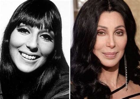 Cher Multiple Plastic Surgery Procedures For Youthful Look