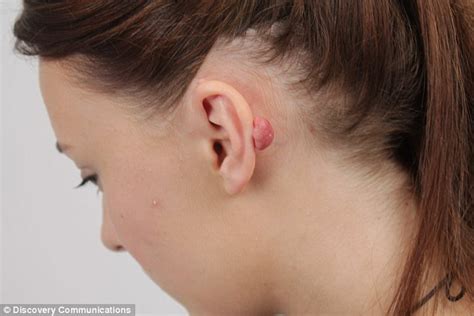 Student Left With Keloid Scar After Ear Piercing As An Act Of Teenage