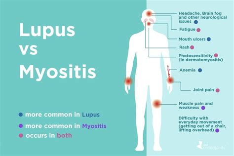 Lupus Vs Myositis Differences In Symptoms And Treatments