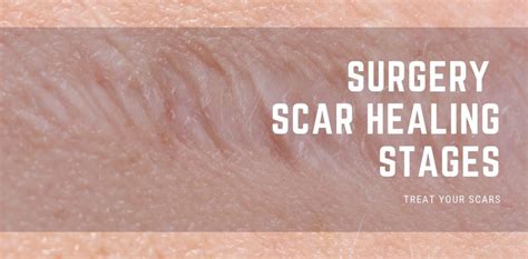Surgery Scar Healing Stages Treat Your Scars
