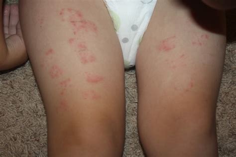 Sea Lice Rashes Pictures Photos My Xxx Hot Girl