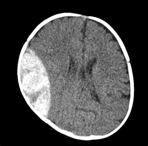 Severe Anemia Associated With Intracranial Hemorrhage In An Infant