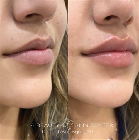 Lip Augmentation La Beauty Skin Center Usa