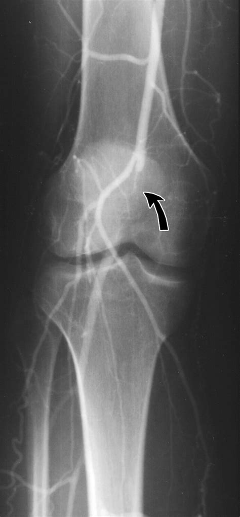 Popliteal Artery Entrapment Syndrome Role Of Imaging In The Diagnosis