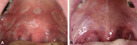 Apremilast For Treatment Of Recalcitrant Aphthous Stomatitis Jaad Case Reports
