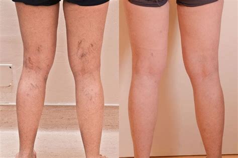 Varicose Veins Secrets Review Works Or Just A Scam