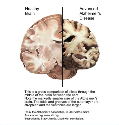 The Healthy Brain Left And The Alzheimer S Brain Right Download Scientific Diagram