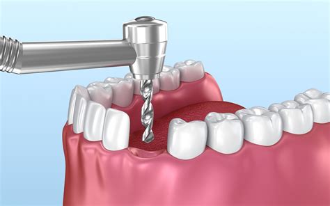 1888 dental implant 3d models. Dental implant instalation animation 3D model - TurboSquid ...