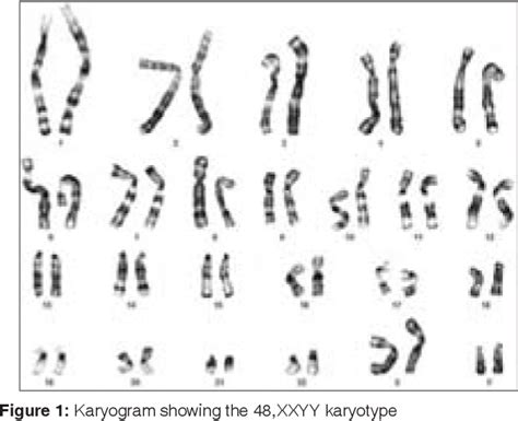 Figure From An Adolescent With Xxyy Syndrome With