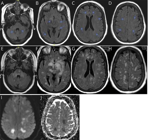 Clinical Reasoning A 59 Year Old Woman Presenting With Diplopia