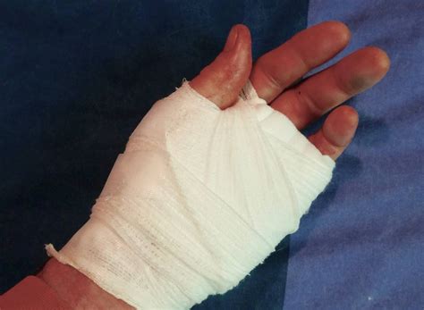 Newblog The Freak Accident That Cost Me A Finger