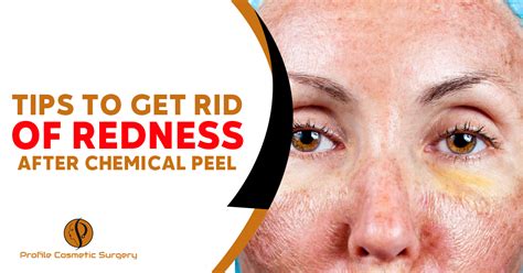 How To Treat Red Skin After Chemical Peel Cosmetic Surgery Tips