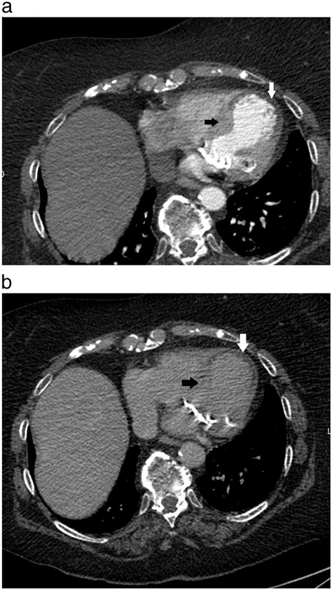 Contrast Enhanced Ct Realized 75 Minutes After The Onset Of Pain