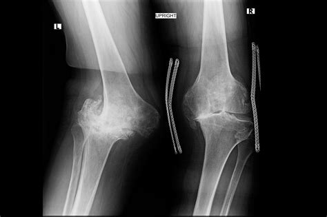 So, it is very important to understand the cause of pain behind the knee and take necessary steps to get rid of it. Case Study: Severe Knee Pain and Disability - Clinical ...