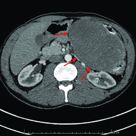 Ct Scan With Contrast In Arterial Phase Showing The Dt In The Left