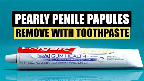 How To Remove Ppp Pearly Penile Papules Using Fluoride Toothpaste