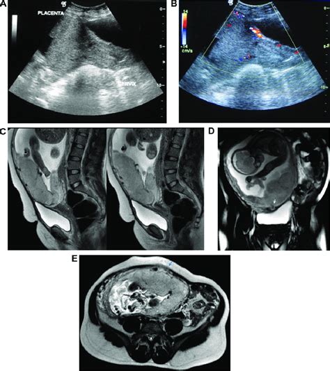 Placenta Previa Complete Anterior Both Us And Mri Show No Features