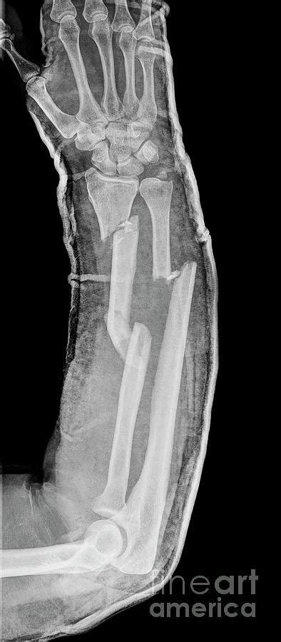Fractured Lower Arm Bones Photograph By Science Photo Library