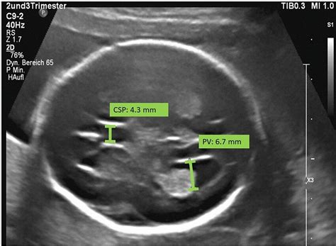 Transventricular Plane Of A Fetus In A Normal Pregnancy At The 24th