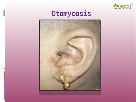 Otomycosis Causes Symptoms Daignosis Prevention And Treatment By