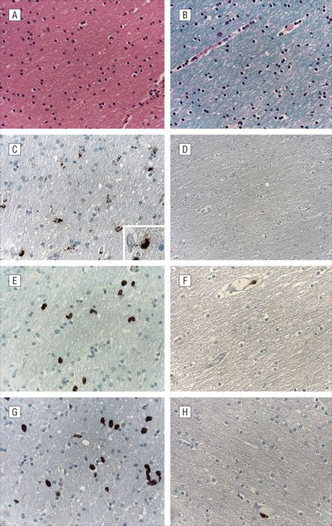 neuroinflammation and demyelination in multiple sclerosis after allogeneic hematopoietic stem