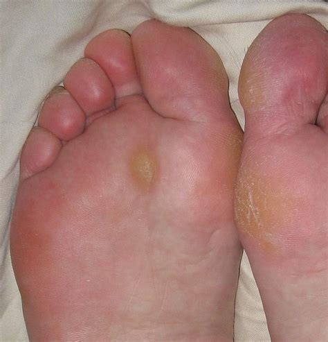 Red Bumps On Foot Hot Sex Picture