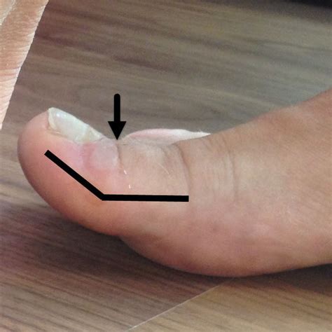 Toenail Blisters 7 Causes 7 Fixes Toe Nails Blister On Toe Toe