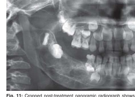Figure 11 From A Radiological Review Of Ewings Sarcoma Of Mandible A