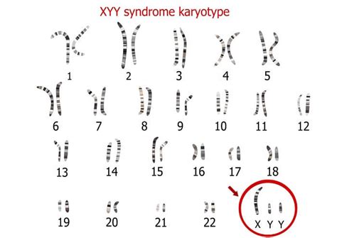 Turner Syndrome Xo Chromosome Maeteroch