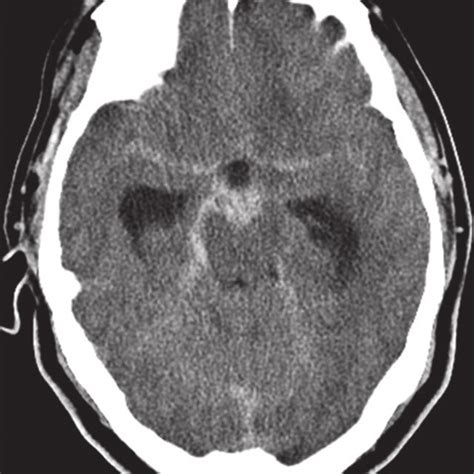 Initial Ct Examination Showing A Subarachnoid Hemorrhage Download