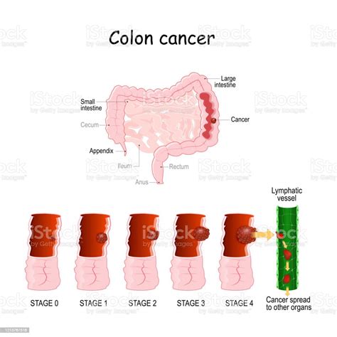 Colon Cancer Colorectal Oncology Development Of A Malignant Tumor From