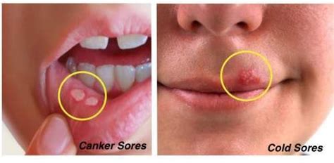find out the difference between cold sores and canker sores canker sore cankers cold sore