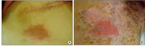 Case Series Of Different Onset Of Skin Metastasis According To The
