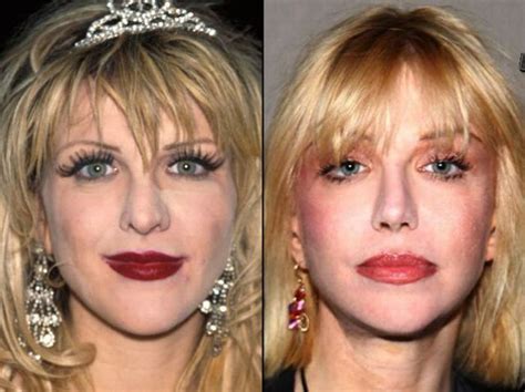 Celebrities Before And After A Plastic Surgery Pics