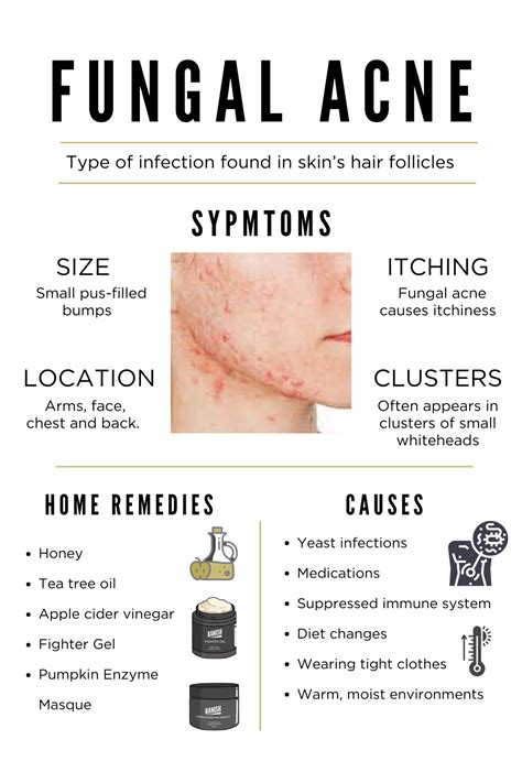 Acne and more acne how do you get rid of acne what are the main types