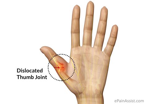 Thumb Paincausessymptomstreatmentdiagnosis