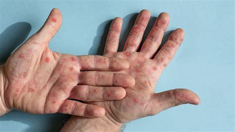 What Are The Symptoms Of Monkeypox Sharp Healthcare