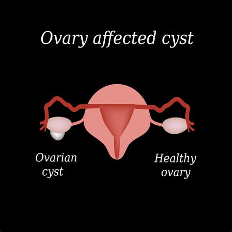 Uterus Ovaries And Sounds