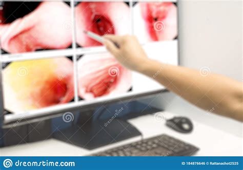 Medical Image Gastrointestinal Endoscopic Examination Image Showing